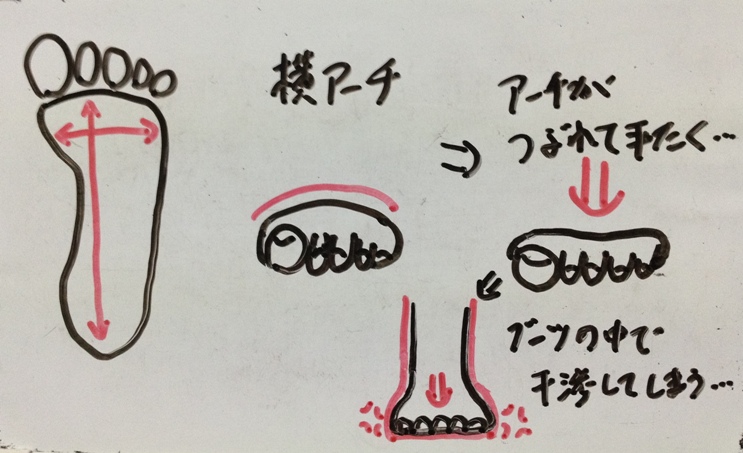 スキー　　ランニング　外反母趾