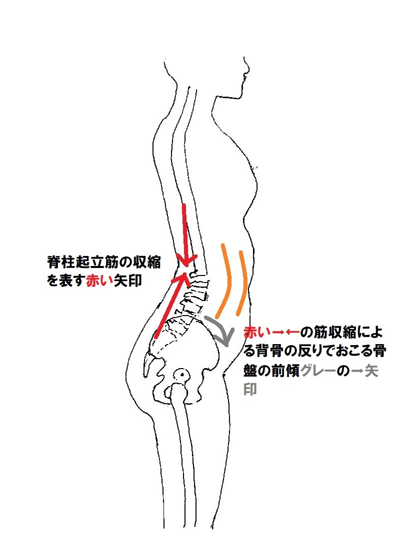 反り腰大転子出っ張り