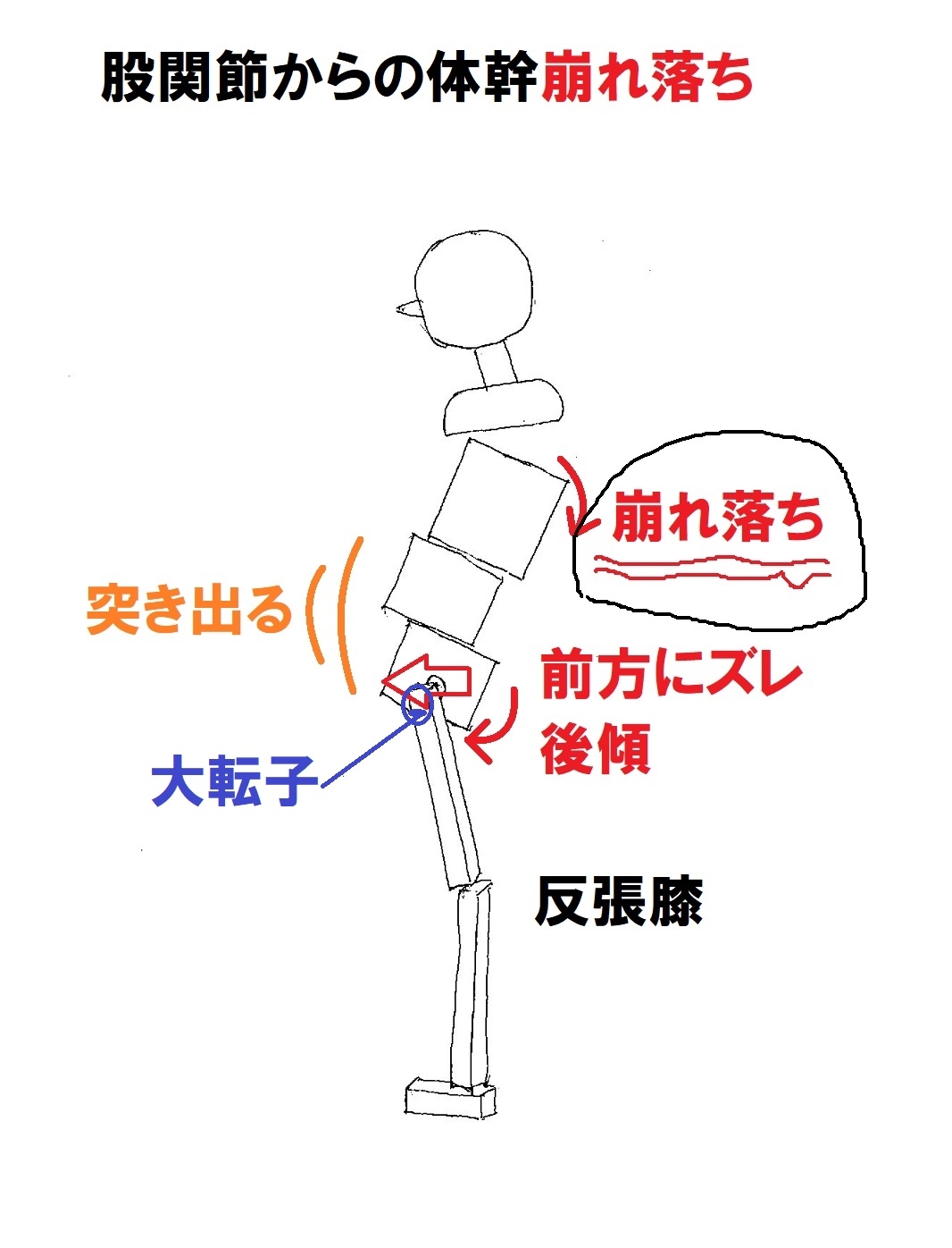 胸椎崩れ落ち