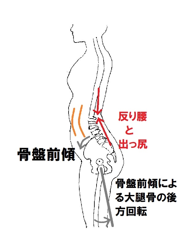 反り腰の説明